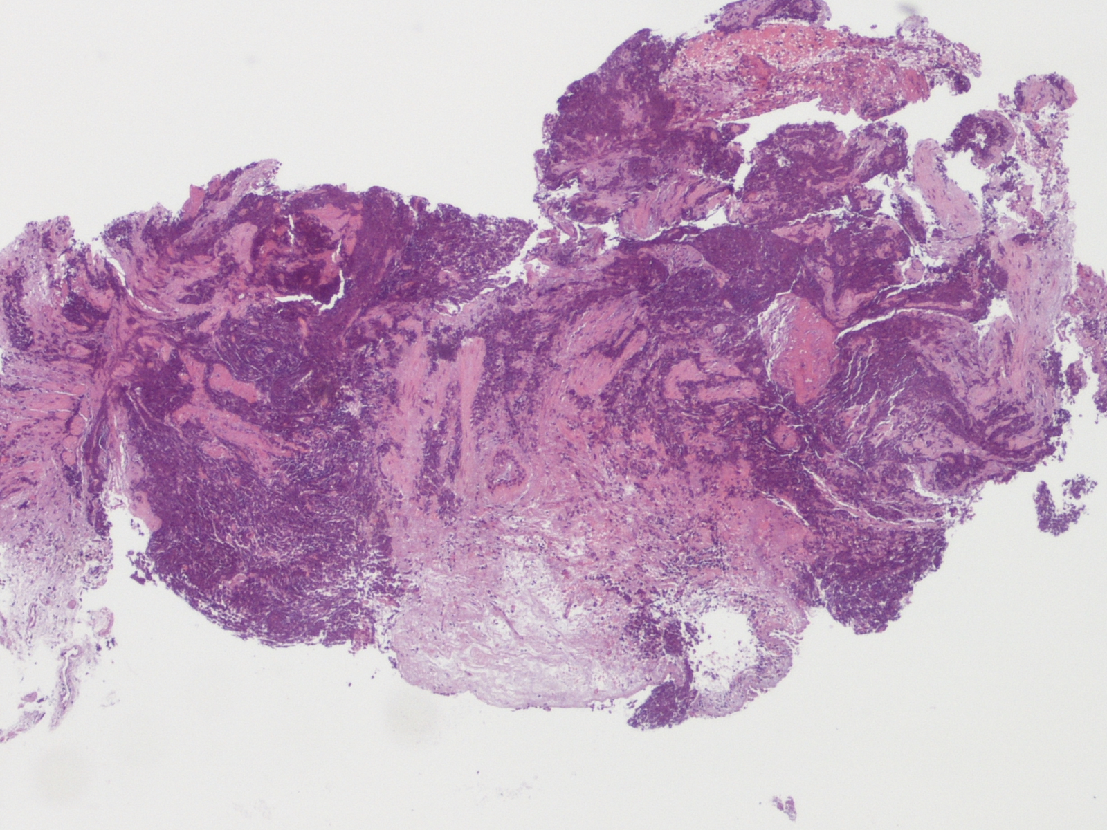 Mesothelioma Diagnosis Lung X ray Histology CXR CT Cancer Ribbon 