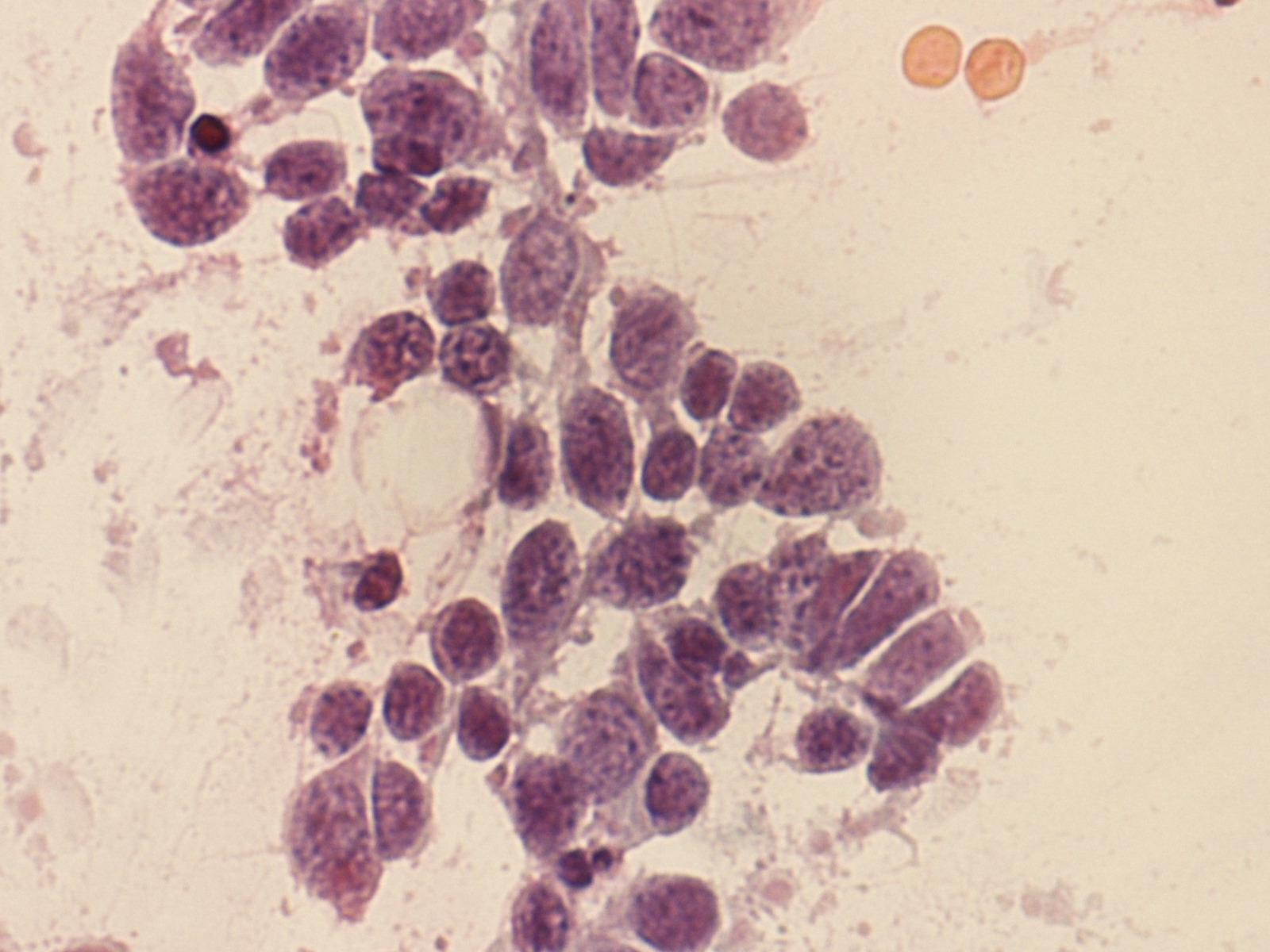 CASE N°29 - Pulmonary Small Cell Carcinoma | cytology blog ...
