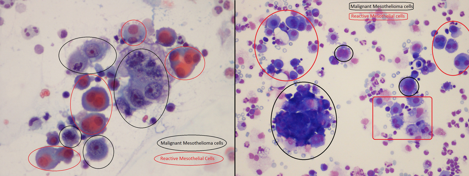 Атипичные клетки в цитологии что это. Цитология плевральной жидкости. Опухолевые клетки в плевральной жидкости микроскопия. Цитологическое мезотелиома. Мезотелиома в плевральной жидкости.